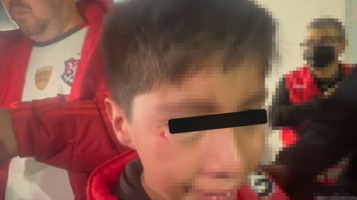 Madre de niño agredido con bengala por hinchas de la UC: 