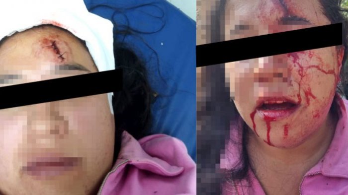 Movilh denuncia ataque a pareja lésbica: Víctima fue golpeada con un bloque de cemento