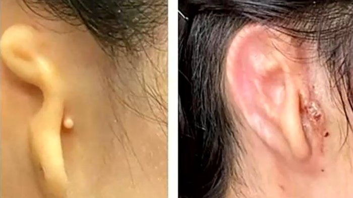 Mujer recibe exitoso trasplante de oreja 3D