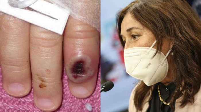 Minsal declara alerta sanitaria por contagios de viruela del mono en Chile