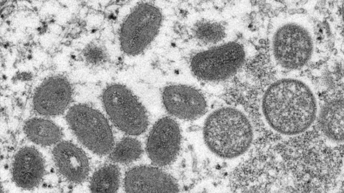 Minsal informa de dos nuevos casos de Viruela del Mono: Ocho son los contagiados a nivel nacional