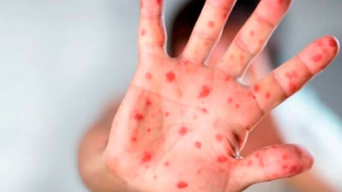 Ministro de Salud de Bolivia reportó un caso de rubéola después de 16 años