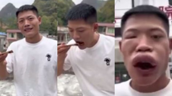 Influencer se comió una avispa viva para sumar seguidores en TikTok y terminó con su cara deformada