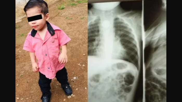 Guagua tragó accidentalmente una pila: Está grave, con daños en esófago y pulmones