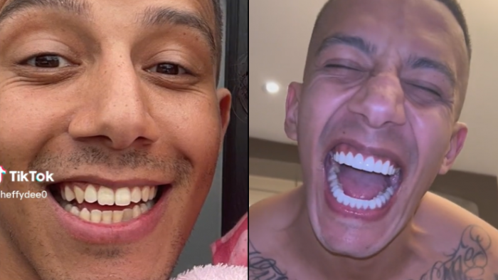 Pagó más de $3,6 millones: Tiktoker se hizo especial tratamiento dental, pero resultado no gustó a seguidores