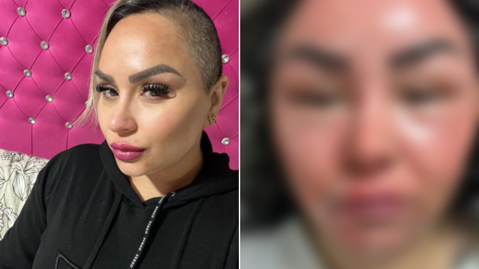 Impactantes imágenes: Influencer Karencita Frías sufrió graves heridas tras explosión de olla a presión