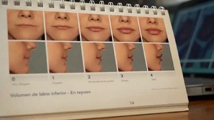 El boom de chilenas operándose en Mendoza: Precios bajos son el principal 