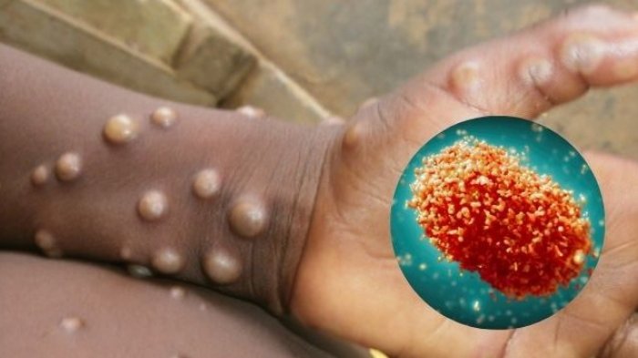 Síntomas y contagio: Por qué se declaró una alerta por Mpox, ex “viruela del mono”, en Chile