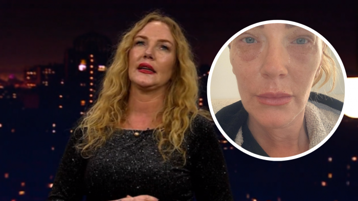 Catalina Pulido mostró los impactantes resultados de innovador retoque estético en sus párpados