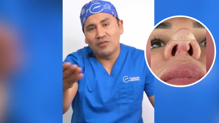 Chilenas denuncian negligencias en cirugías estéticas en Tacna: Quedaron con peligrosas infecciones