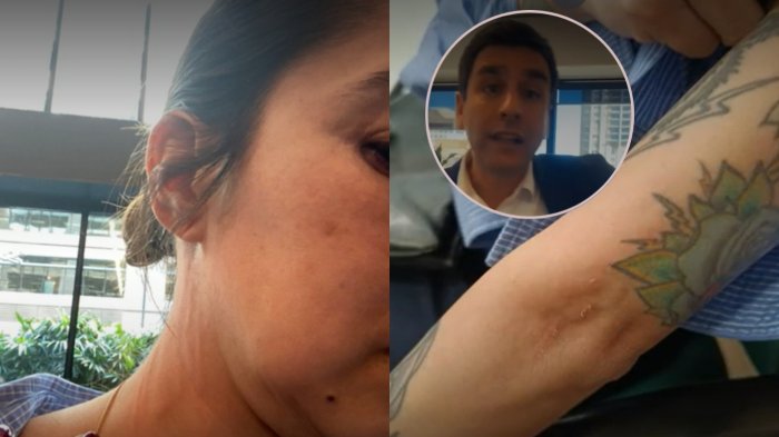 VIDEO | Chilena que denunció a cónsul en Sídney mostró lesiones en su brazo y cuello tras presunta agresión