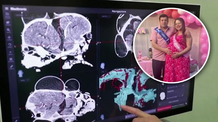 Madre espera trillizas y dos son siamesas: Familia pide ayuda para costear riesgosa operación