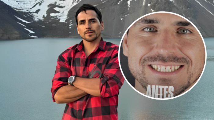 La nueva sonrisa de Pangal Andrade: ¿En qué consiste el procedimiento estético que se realizó?