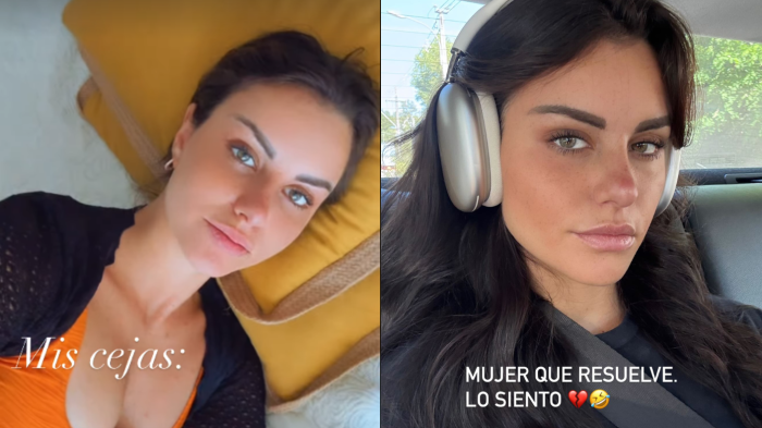 “Eran un tema”: Emilia Dides se realizó drástico procedimiento estético para el Miss Universo