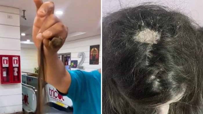 Joven denuncia graves quemaduras tras procedimiento capilar en Quilpué: “No se hacen responsables”