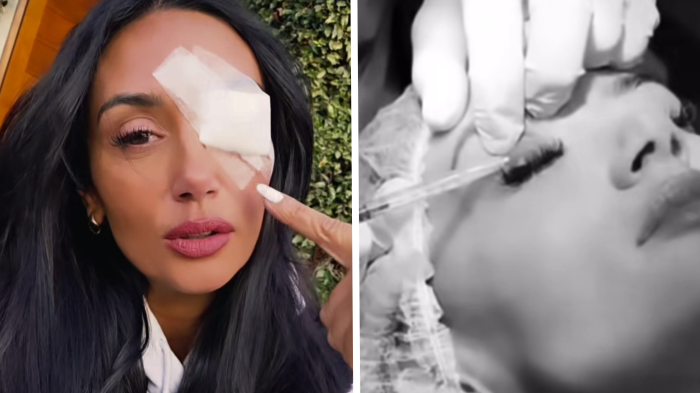 Qué es un chalazión, dolencia que obligó a Pamela Díaz a realizarse delicada cirugía