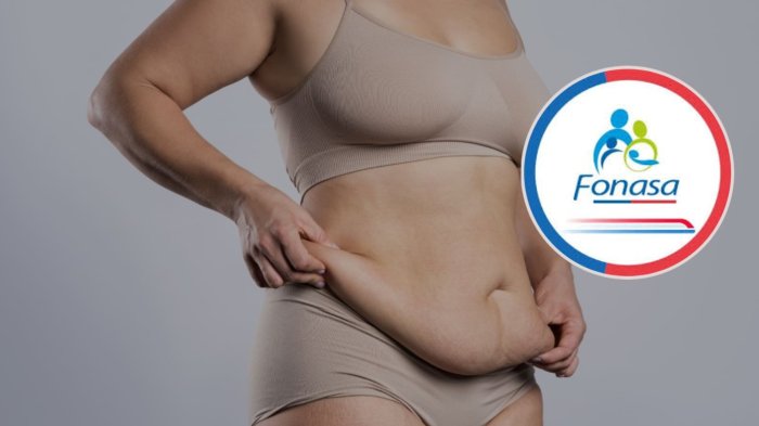 Bono PAD de Fonasa ahora incluye abdominoplastia: Revisa quienes pueden acceder