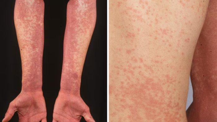 ¿Qué es la fiebre escarlata que hizo suspender clases en Talca? Principales síntomas y riesgos