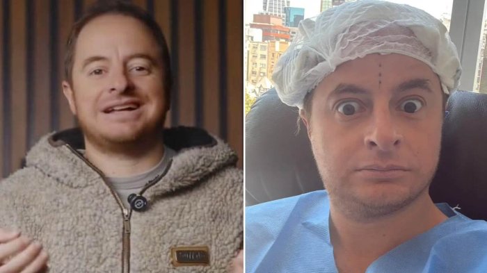 “Remontada épica”: Coke Hevia impacta con cambio radical a 6 meses de implante capilar