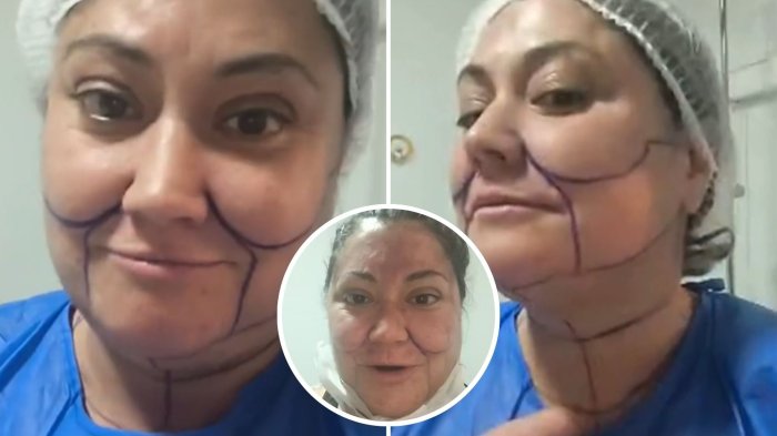 “Me va a sacar...”: Denisse Campos impactó al mostrar resultados de intervención estética