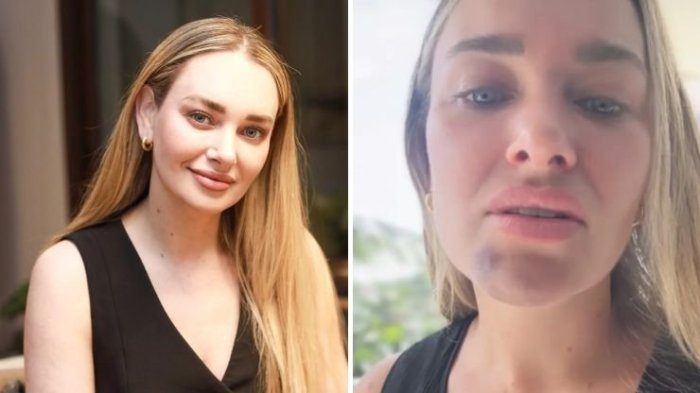 Daniela Nicolás muestra cómo quedó su rostro tras accidente casero: “Se me deformó la cara”