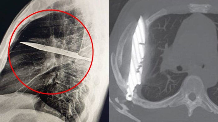 Fue al hospital, se atendió y descubrió que llevaba 8 años con un cuchillo entre sus costillas