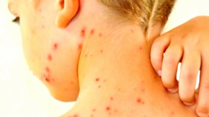 Minsal emite alerta epidemiológica por alza de casos de sarampión en países vecinos