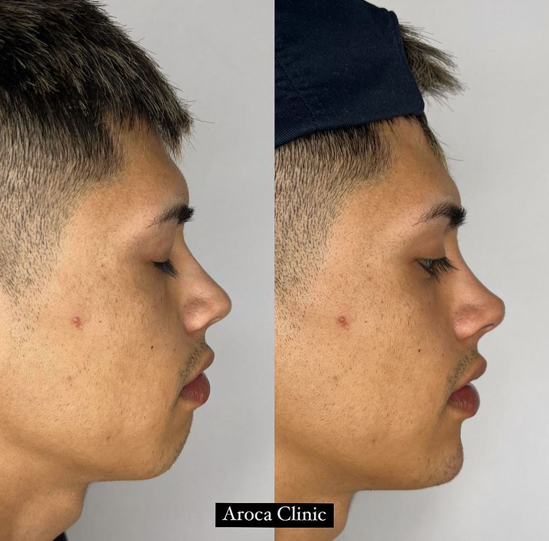 Antes y después de procedimiento estético de Cris MJ. Fuente: Instagram (@aroca.clinic)